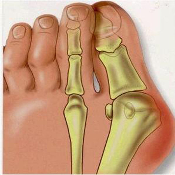 Orthotics Toe Separator